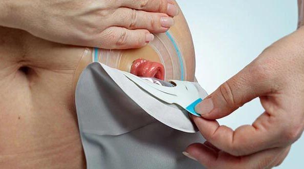 What is a colostomy bag?